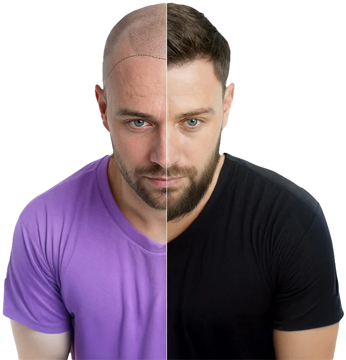 Haartransplantatie Turkije