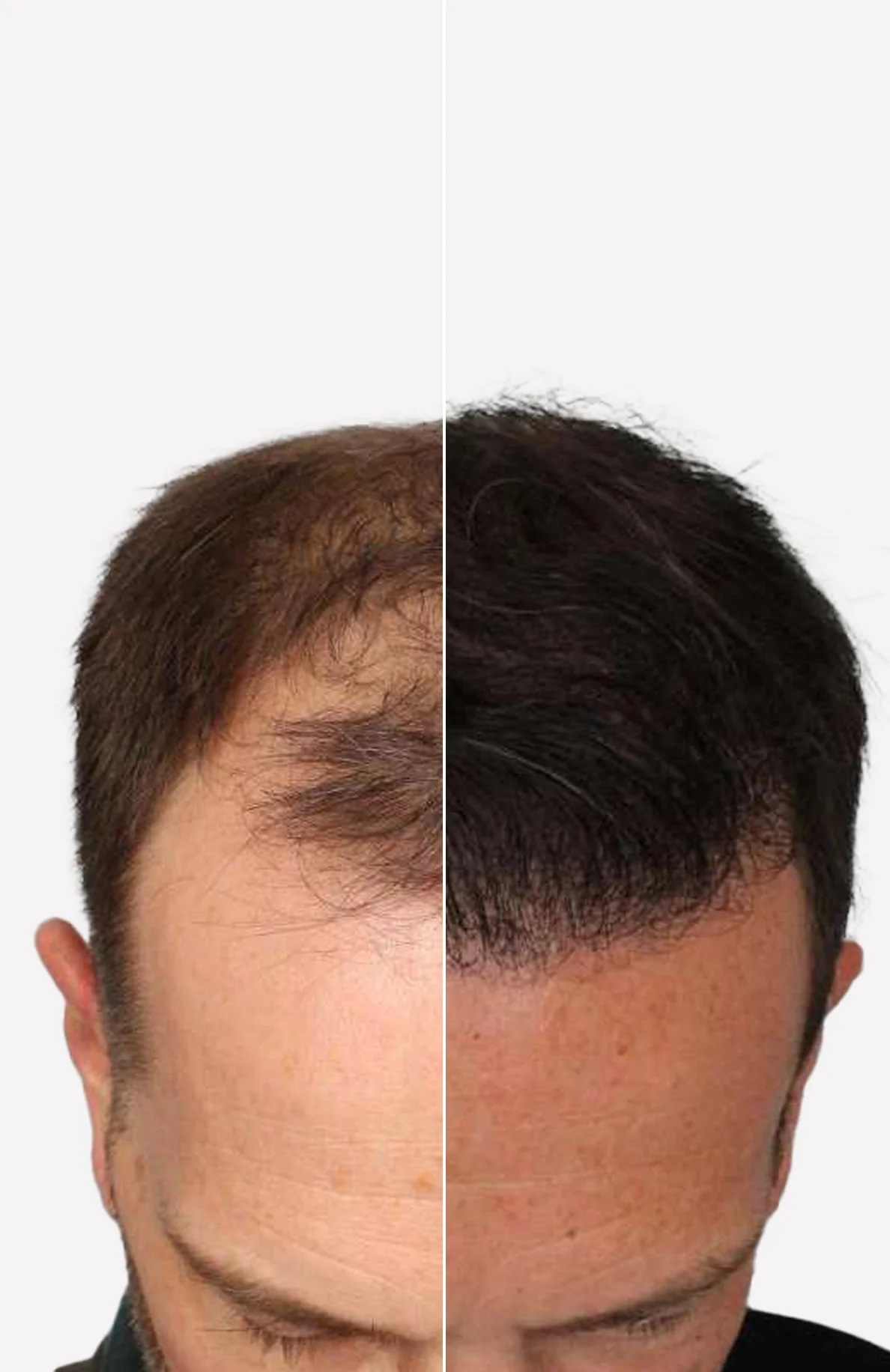 Wanneer zie je resultaat na een haartransplantatie?