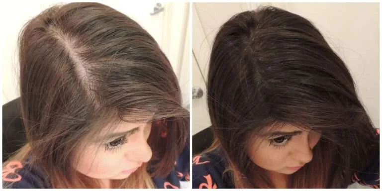 Haartransplantatie voor Vrouwen